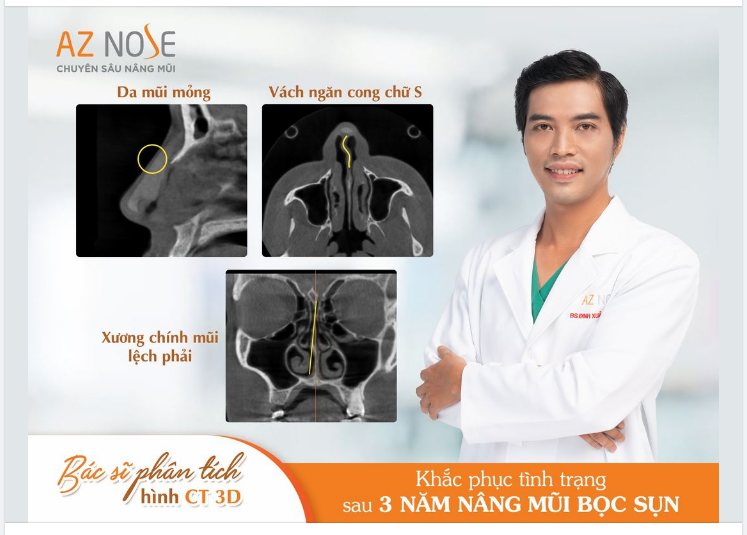 Tái tạo dáng mũi sau 3 năm nâng bọc sụn