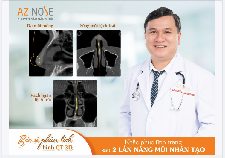 Tái tạo dáng mũi Sline cao cho nàng mẫu ảnh