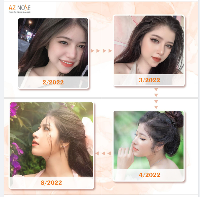Tạm biệt dáng mũi kém thon gọn do t.iê.m filler, Nàng Gen Z toả sáng với dáng mũi Sline thanh tú