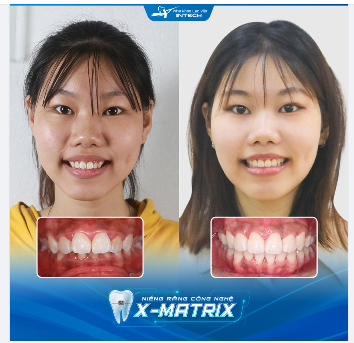 TẠM BIỆT RĂNG HÔ NHỜ NIỀNG RĂNG CÔNG NGHỆ X-MATRIX