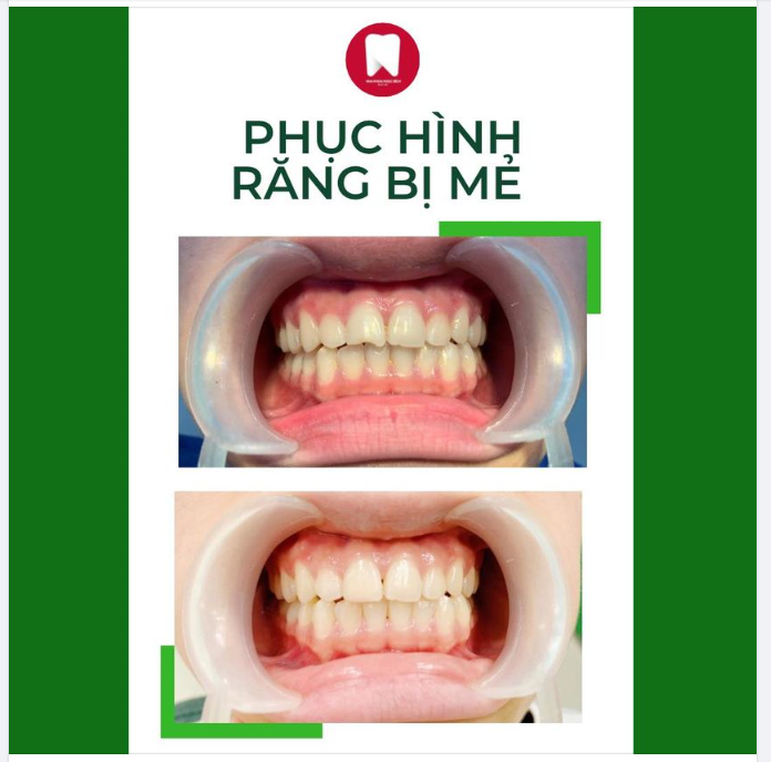 TẠM BIỆT RĂNG MẺ ĐÓN NỤ CƯỜI TƯƠI