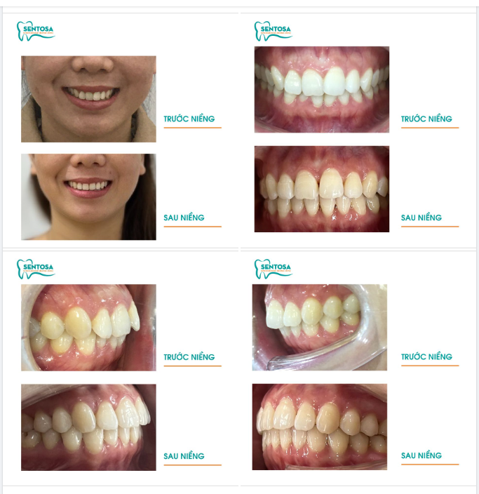 TẠM BIỆT TÌNH TRẠNG RĂNG KHẤP KHỂNH VỚI NIỀNG RĂNG INVISALIGN TẠI NHA KHOA SENTOSA