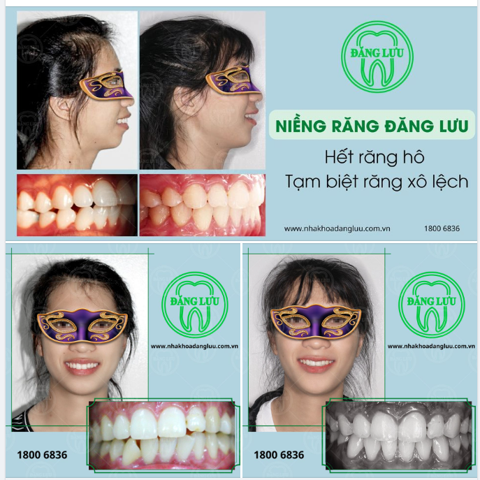 Tăng thẩm mỹ nụ cười   mang đến một sức khỏe răng miệng lành mạnh
