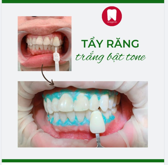 TẨY ​​​​​​​ TRẮNG - SÁNG BẬT TONE