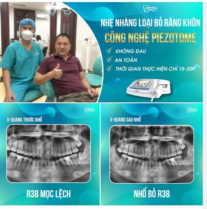 THÁCH THỨC MUÔN HÌNH VẠN TRẠNG RĂNG KHÔN VỚI CÔNG NGHỆ PIEZOTOME