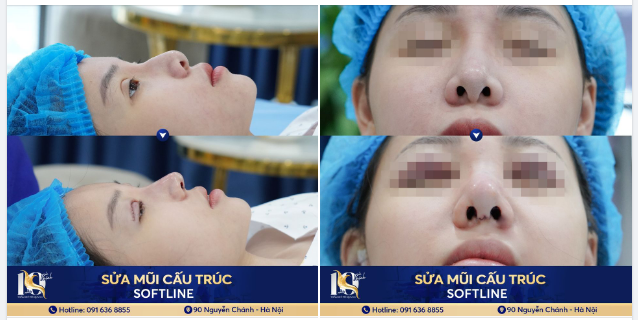 Thẩm mỹ mũi hỏng - Hơn cả sự tự ti, đó là nỗi mặc cảm, nỗi đau...