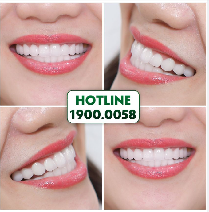 ​​​​​​​THẨM MỸ RĂNG HÔM NAY ĐỂ SỞ HỮU NỤ CƯỜI NHƯ Ý