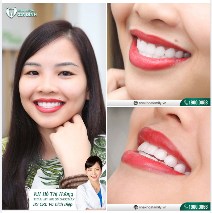 ​​​​​​​THẨM MỸ RĂNG SỨ CÙNG CHUYÊN GIA TẠI NHA KHOA GIA ĐÌNH