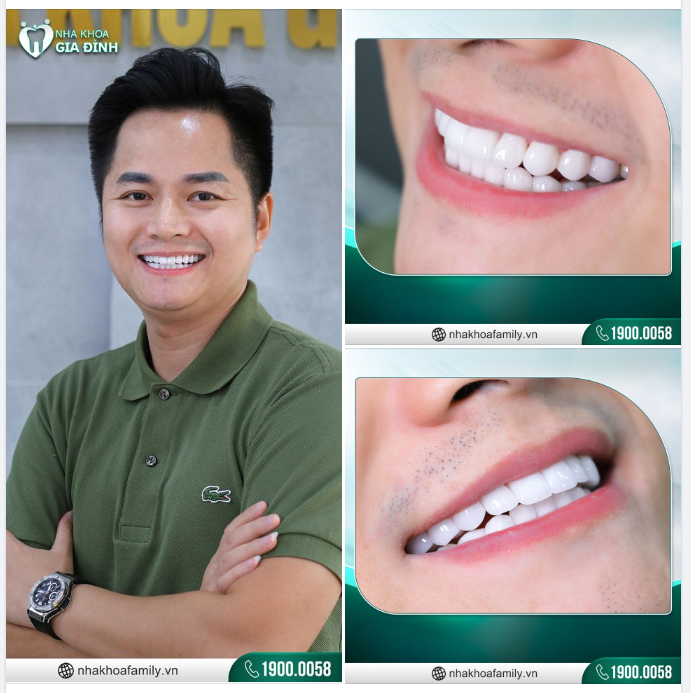 THẨM MỸ RĂNG SỨ ĐỂ CÔNG VIỆC THUẬN LỢI HƠN