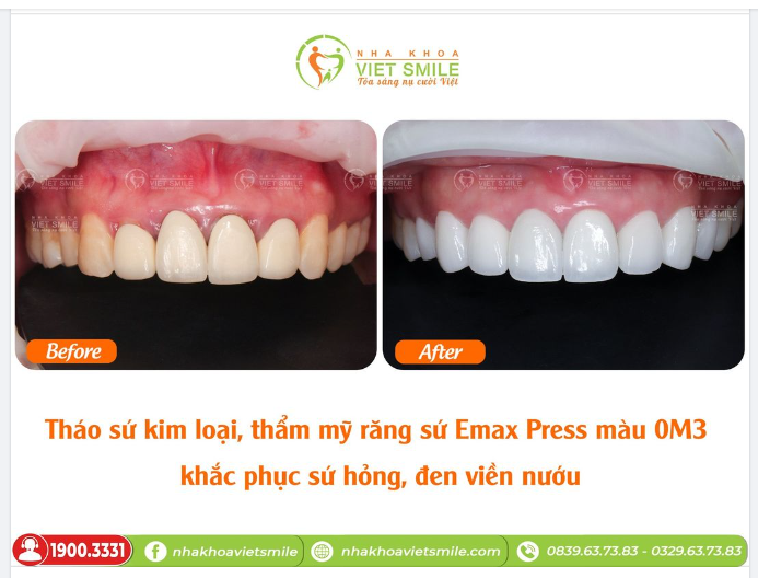 THẨM MỸ RĂNG SỨ EMAX PRESS MÀU OM3 - KHẮC PHỤC SỨ KIM LOẠI HỎNG, ĐEN VIỀN NƯỚU