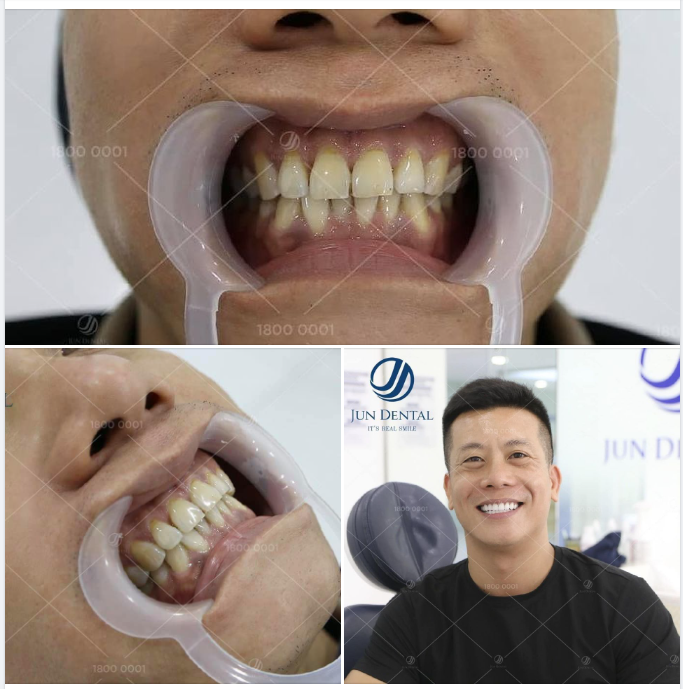 Thẩm mỹ răng sứ không chỉ cần đẹp mà còn phải khoẻ, bền, dễ dàng trong sử dụng hàng ngày.