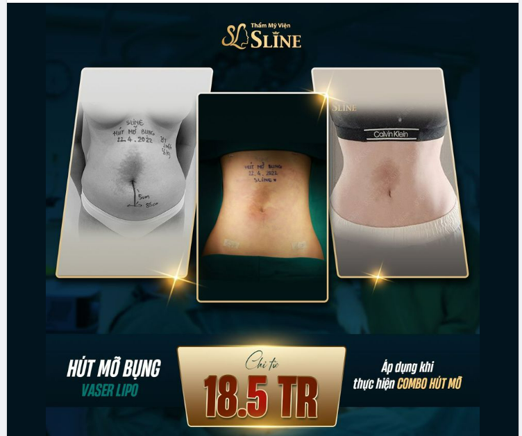 THÁNG 10 Chiến dịch hút mỡ giảm đến 50%, chỉ từ 18,5tr