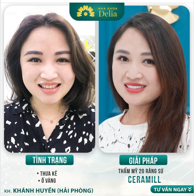 Thăng hạng nhan sắc, chốt sale thành công khi làm răng sứ tại Delia