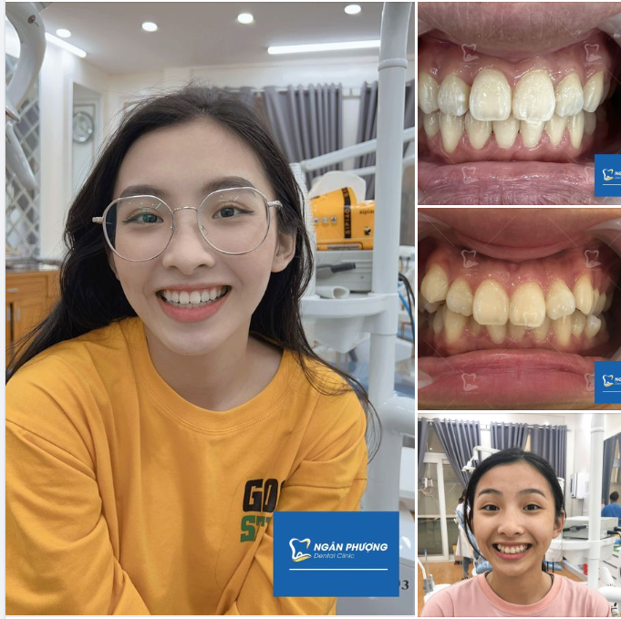 Tháo niềng đúng ngày sinh nhật cơ sở Sài Gòn, Hồng Giàu muốn lan tỏa niềm vui đến tất cả đồng niềng