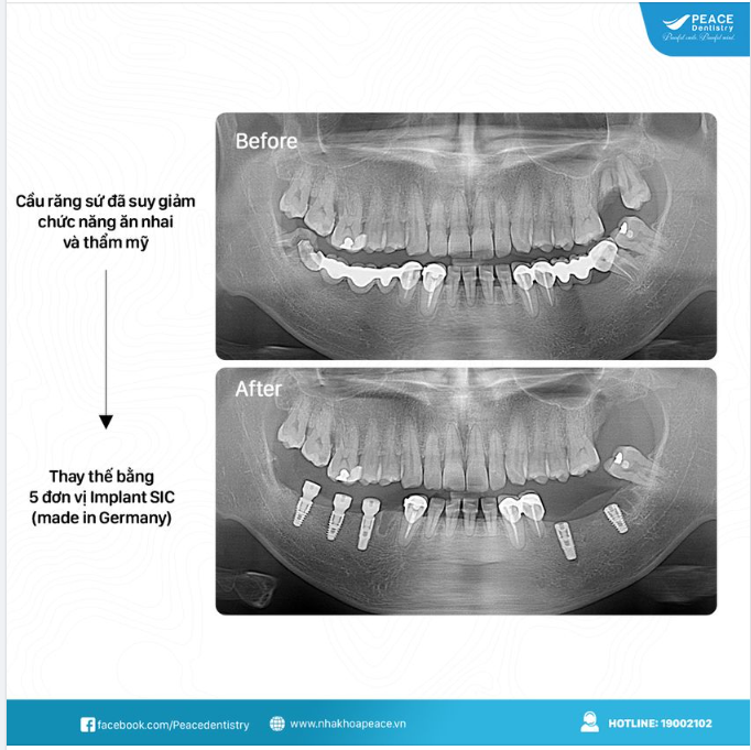 Thay cầu răng sứ bằng Implant  khôi phục trọn vẹn sức nhai  cải thiện thẩm mỹ nụ cười như thời thanh xuân