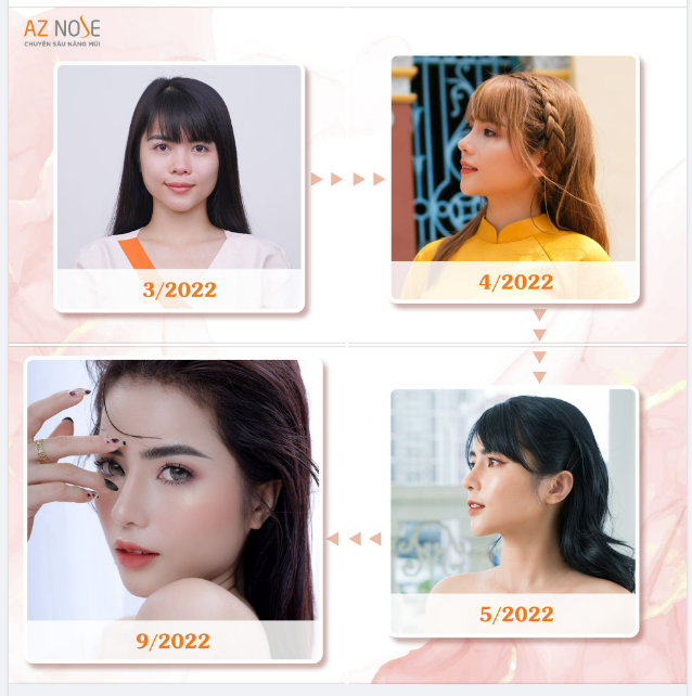 THAY DÁNG MŨI - ĐỔI THẦN THÁI