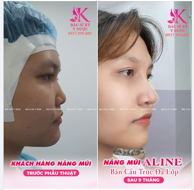 THAY ĐỔI CẢ GƯƠNG MẶT CHỈ VỚI MỘT CHIẾC MŨI
