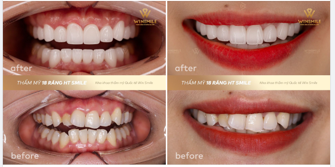 THAY ĐỔI FORM DÁNG, BỪNG SÁNG NỤ CƯỜI CÙNG WIN SMILE