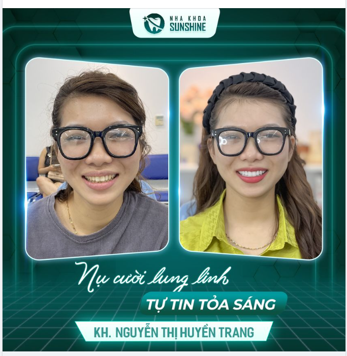 THAY ĐỔI NỤ CƯỜI LÀ THAY ĐỔI CẢ KHUÔN MẶT