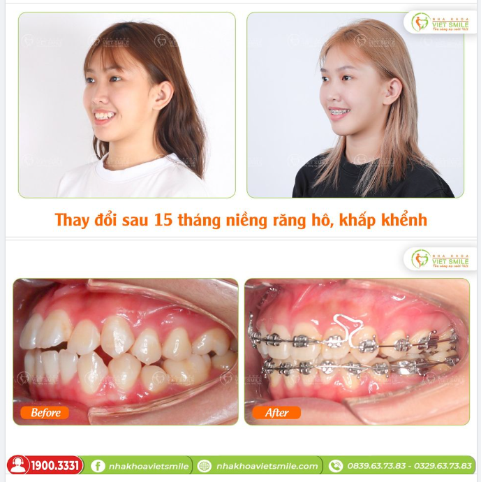 THAY ĐỔI SAU 15 THÁNG NIỀNG RĂNG HÔ, KHẤP KHỂNH