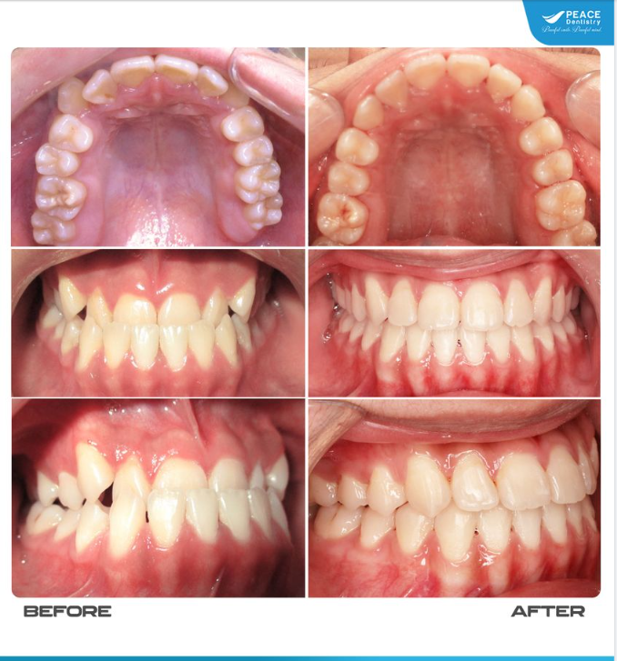 THAY ĐỔI THẨM MỸ NỤ CƯỜI VỚI NIỀNG RĂNG CHỈNH MÓM