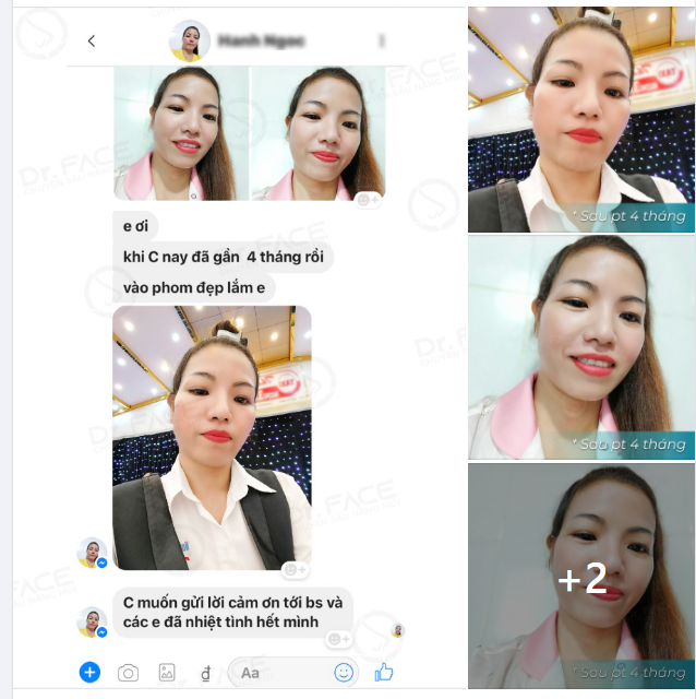 THAY MỚI CHIẾC MŨI BỊ CO RÚT CÓ SẸO ĐẦU MŨI