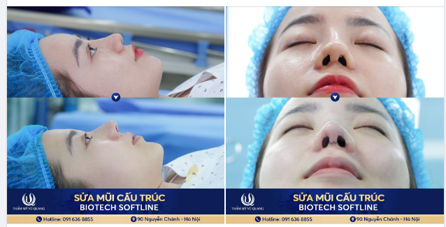 Thêm 1 Kết quả Sửa mũi lệch, mũi lộ chất liệu dành cho cả nhà tham khảo.