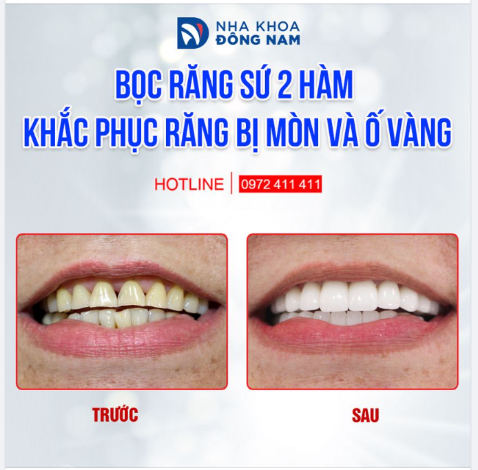 THÊM MỘT NỤ CƯỜI NHỜ BỌC RĂNG SỨ THẨM MỸ