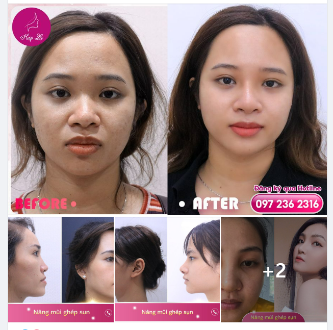 Thêm nhiều hình ảnh phản hồi của khách hàng sau khi chọn Nâng Mũi Bọc sụn tại Hiệp Lợi