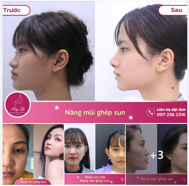 Thêm nhiều hình ảnh phản hồi của khách hàng sau khi chọn Nâng Mũi Ghép sụn tại Hiệp Lợi