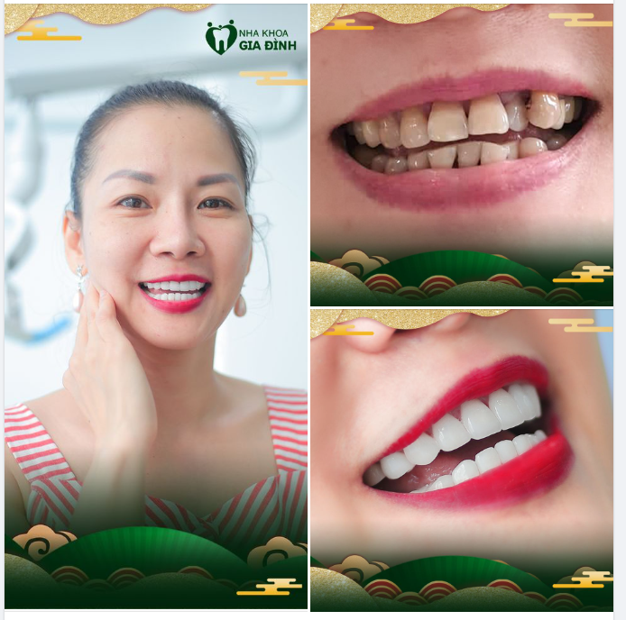 THỜI ĐẠI NÀO RỒI MÀ CÒN ĐỂ RĂNG XẤU? KHẮC PHỤC NGAY HÔM NAY!!!