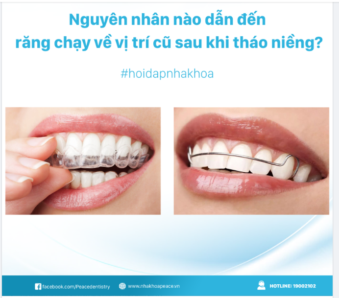 Thời gian đầu sau khi tháo niềng, bạn cần đeo hàm liên tục trong 24h.