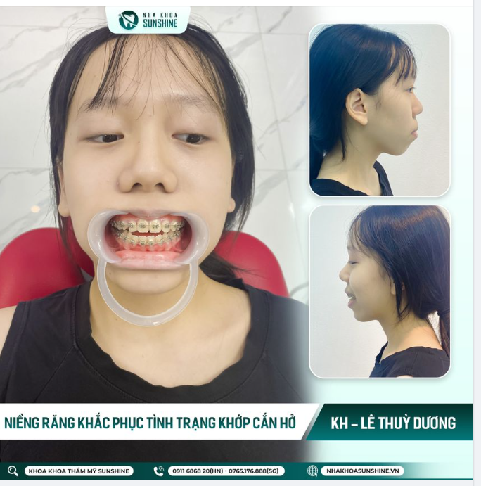 Thực hiện gắn mắc cài kim loại, khắc phục tình trạng khuyết điểm cho răng.