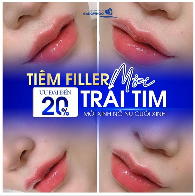 TIÊM FILLER MÔI TRÁI TIM - MÔI XINH NỞ NỤ CƯỜI XINH