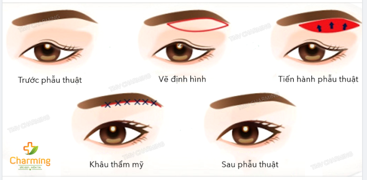 TOP NHỮNG PHẪU THUẬT BỊ HIỂU NHẦM TOP 1 NÂNG CUNG MÀY