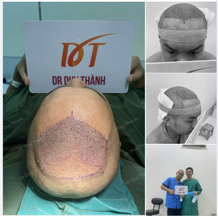 TRẢ KẾT QUẢ CẤY 2000 NANG TÓC HÔM TRƯỚC, KHÁCH NAM 33 TUỔI LAI CHÂU