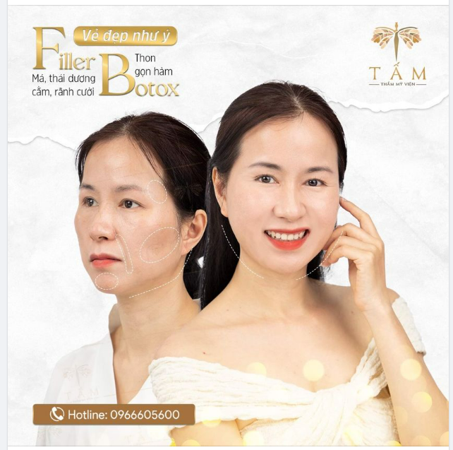 Trải nghiệm ngay combo BOTOX - FILLER biến hình gương mặt đẹp hoàn hảo chuẩn tỉ lệ vàng