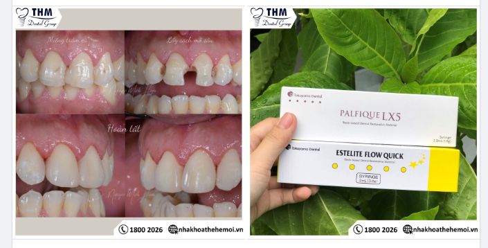 TRÁM THẨM MỸ RĂNG CỬA AN TOÀN, HIỆU QUẢ VỚI VẬT LIỆU COMPOSITE