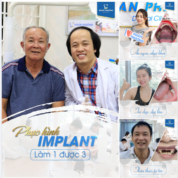Trẻ đẹp dài lâu với trồng răng Implant