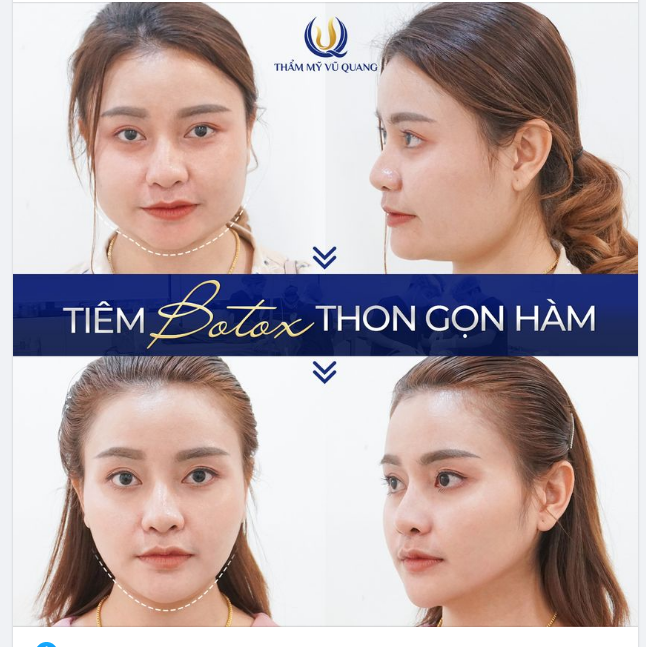 Trẻ xinh hơn 5 tuổi sau khi Tiêm Botox thon gọn hàm.