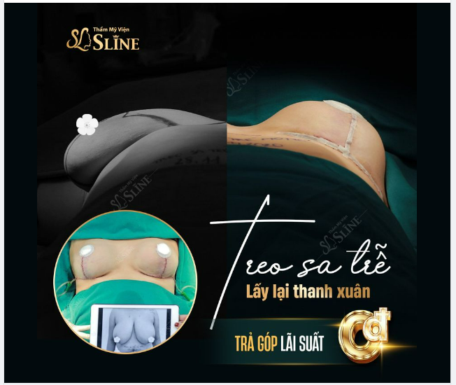 TREO SA TRỄ  THU NHỎ NGỰC PHÌ ĐẠI