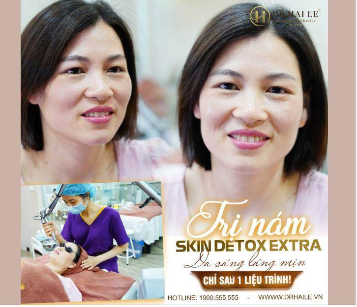 TRỊ NÁM SKIN DETOX EXTRA - NÁM DA CỠ NÀO CŨNG SAY "BYE"