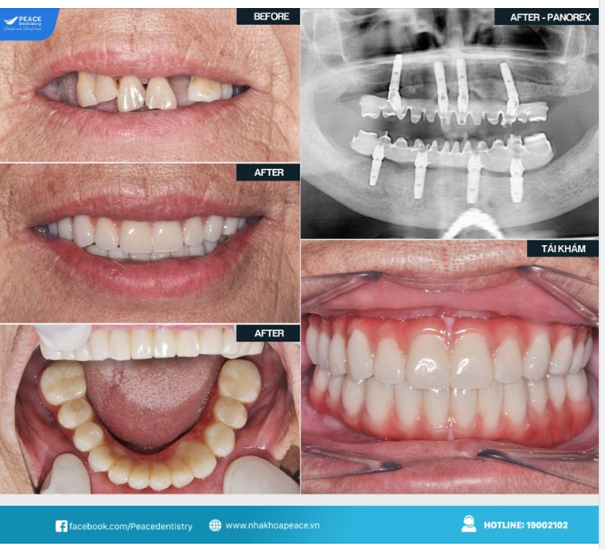Trồng răng implant All-on-4 khôi phục chức năng ăn nhai cho trường hợp mất nhiều răng