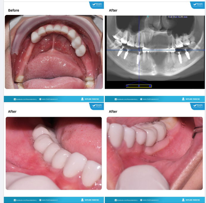 Trồng răng Implant với những trường hợp  mất răng nhiều năm có gì khác biệt?
