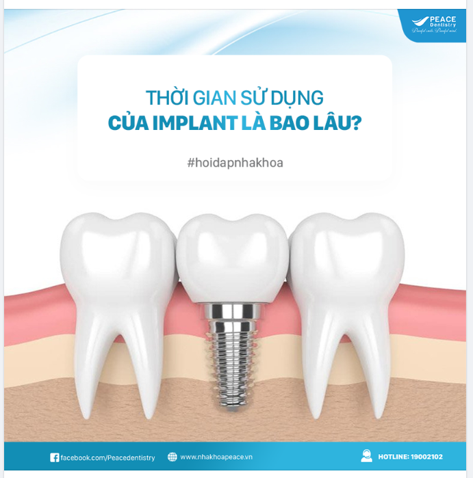 TRỤ IMPLANT SẼ TÍCH HỢP VÀO XƯƠNG HÀM VỮNG CHẮC