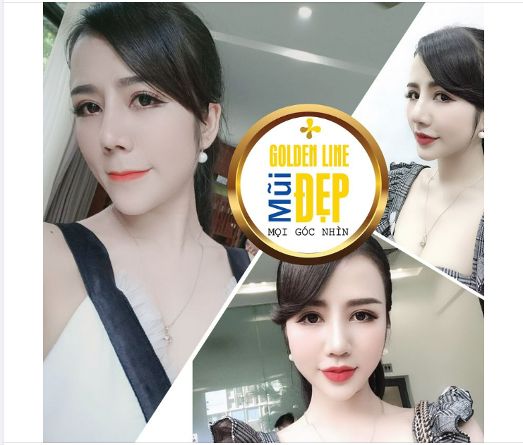 TRƯỜNG HỢP NÀO NÊN CHỌN NÂNG MŨI GOLDEN LINE ️