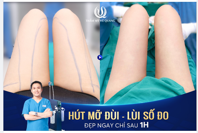 Tự ti vì bắp đùi “cột đình” Là nạn nhân của Body Shamming Dù luyện tập - Kiêng khem cỡ nào đùi cũng không thể nhỏ