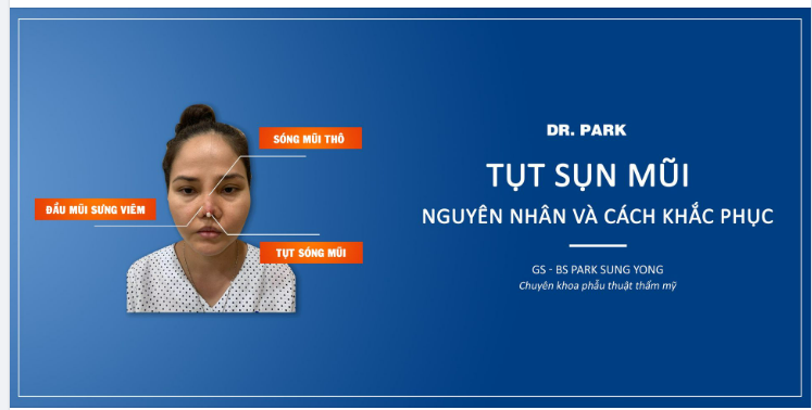 TỤT SỤN MŨI - BIẾN CHỨNG SAU NÂNG MŨI KHẮC PHỤC LÀM SAO