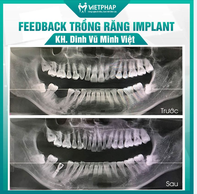 “UI DỜI. MẤT CẢ HÀM MỚI SỢ CHỨ MẤT CẢ RĂNG THÌ SỢ CÁI GÌ”