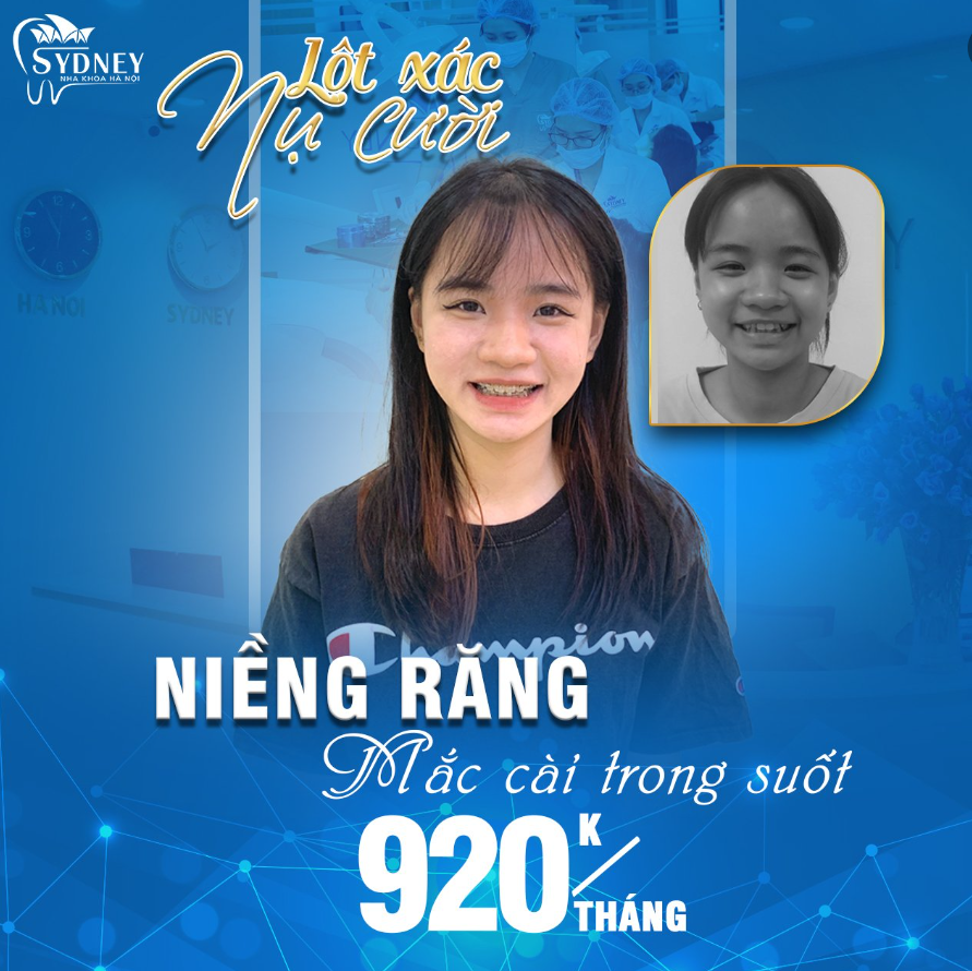 Ưu điểm của niềng răng mắc cài pha lê